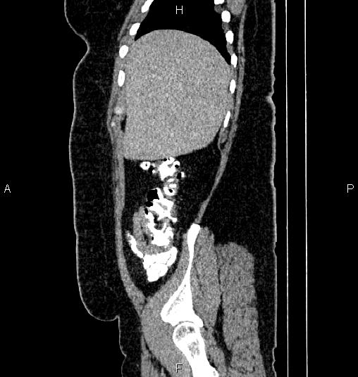 File:Bilateral ovarian dermoid cysts (Radiopaedia 85785-101603 D 12).jpg