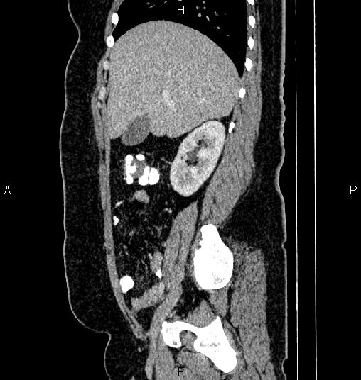 File:Bilateral ovarian dermoid cysts (Radiopaedia 85785-101603 D 25).jpg