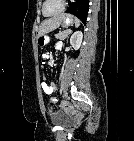 Bilateral ovarian dermoid cysts (Radiopaedia 85785-101603 D 59).jpg
