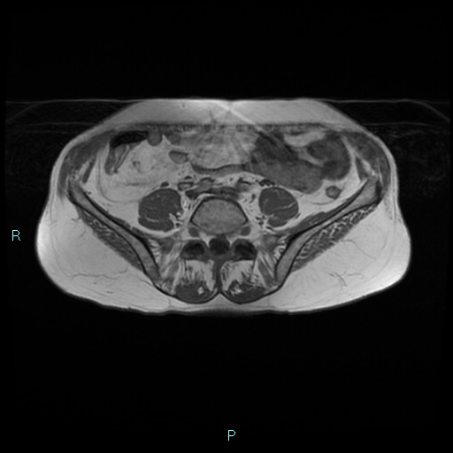 File:Bilateral ovarian fibroma (Radiopaedia 44568-48293 Axial T1 1).jpg