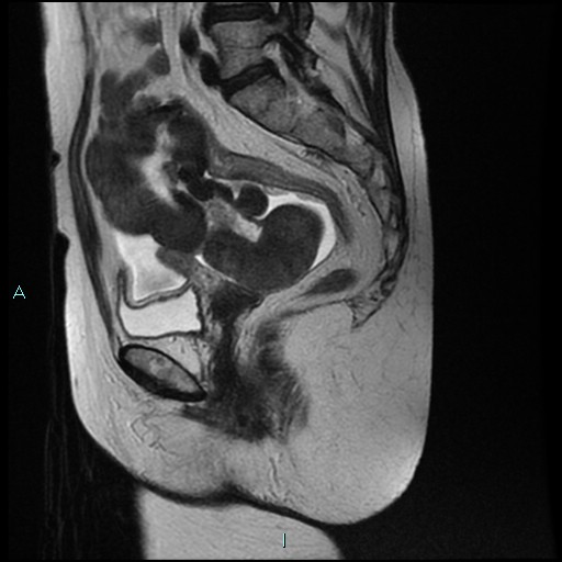 File:Bilateral ovarian fibroma (Radiopaedia 44568-48293 Sagittal T2 15).jpg