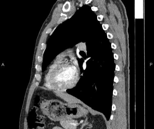 Bilateral pulmonary AVM (Radiopaedia 83134-97505 D 73).jpg