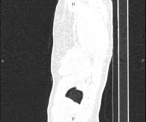 Bilateral pulmonary AVM (Radiopaedia 83134-97505 Sagittal lung window 108).jpg