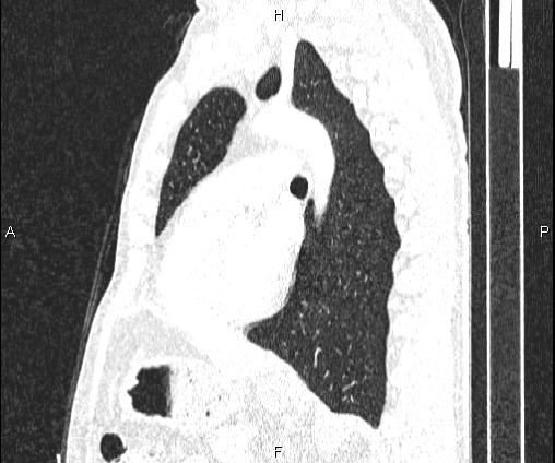 Bilateral pulmonary AVM (Radiopaedia 83134-97505 Sagittal lung window 69).jpg