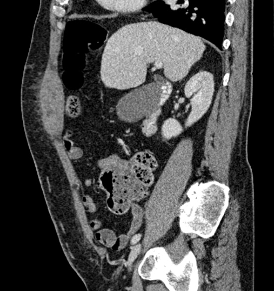 Bilateral rectus sheath hematomas (Radiopaedia 50778-56252 B 29).jpg