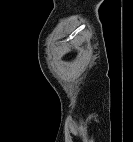File:Bilateral rectus sheath hematomas (Radiopaedia 50778-56252 B 76).jpg