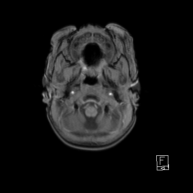 File:Bilateral subdural hemorrhage and parietal skull fracture (Radiopaedia 26058-26190 Axial T1 6).png
