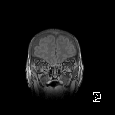 Bilateral subdural hemorrhage and parietal skull fracture (Radiopaedia 26058-26190 Coronal T1 9).png