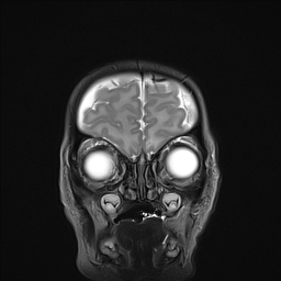 File:Bilateral subdural hemorrhage and parietal skull fracture (Radiopaedia 26058-26190 Coronal T2 2).png