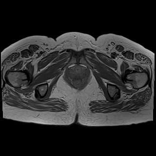 Bilateral tubo-ovarian abscesses (Radiopaedia 58635-65829 Axial T1 C+ 45).jpg