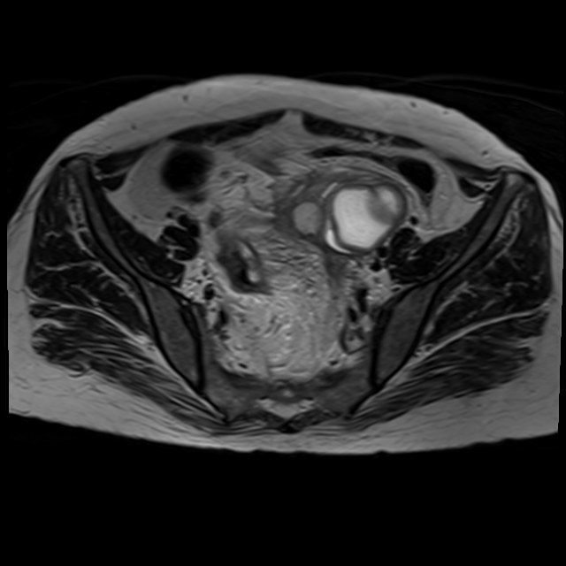 Bilateral tubo-ovarian abscesses (Radiopaedia 58635-65829 Axial T2 15).jpg