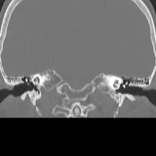 File:Bilateral tympanoplasty (Radiopaedia 16947-16664 Coronal bone window 10).jpg