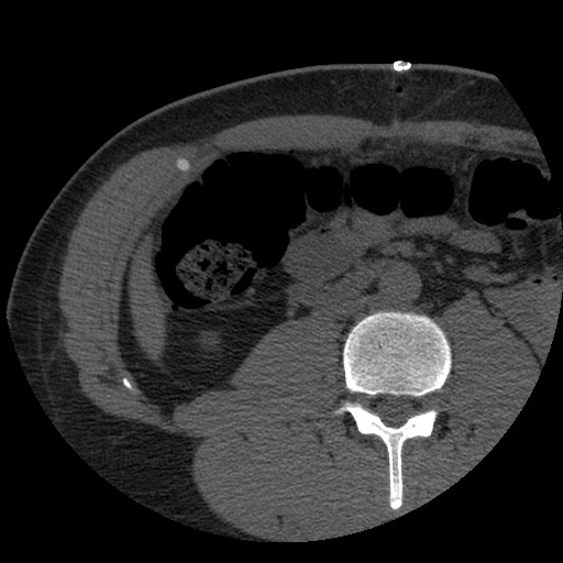 Bile leak from liver traumatic laceration (Radiopaedia 63463-72077 Axial Biliscopin 81).jpg