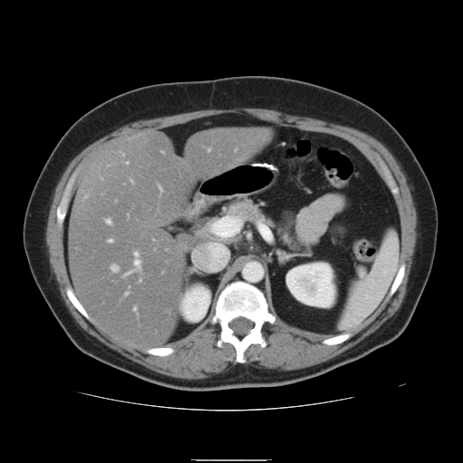File:Billroth I gastric resection (Radiopaedia 17685-17425 None 1).jpg