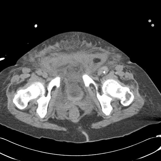 Bladder rupture post renal biopsy (Radiopaedia 30863-31572 Axial non-contrast 85).jpg