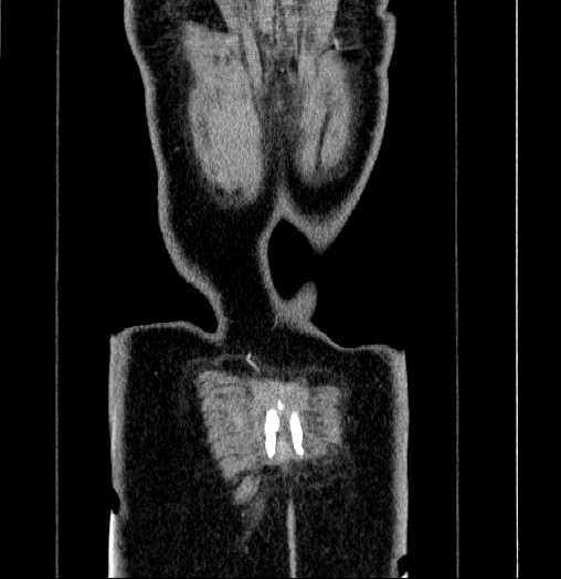 Blind-ending branch of a bifid ureter (Radiopaedia 61159-69048 C 70).jpg