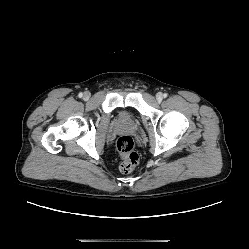 Blunt abdominal trauma with solid organ and musculoskelatal injury with active extravasation (Radiopaedia 68364-77895 A 151).jpg
