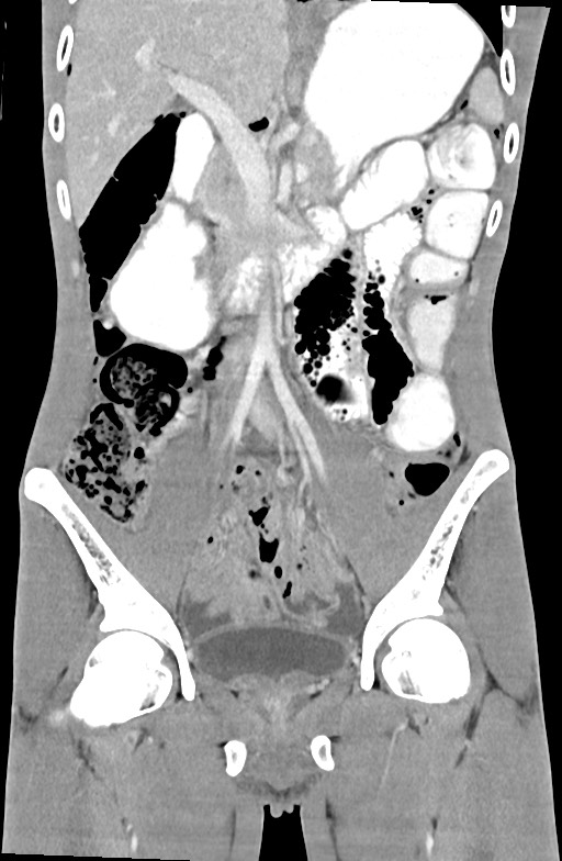 Blunt injury to the small bowel (Radiopaedia 74953-85987 B 45).jpg