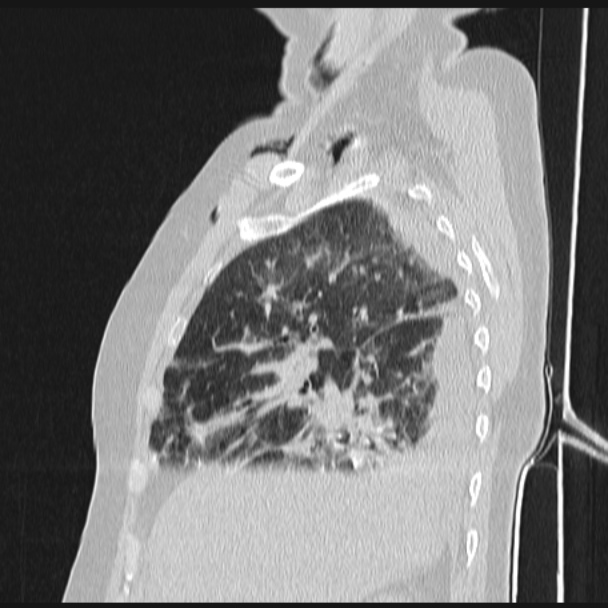 Boerhaave syndrome (Radiopaedia 45644-49799 Sagittal lung window 22).jpg