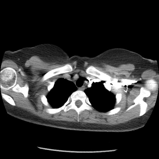 Borderline mucinous tumor (ovary) (Radiopaedia 78228-90808 A 8).jpg