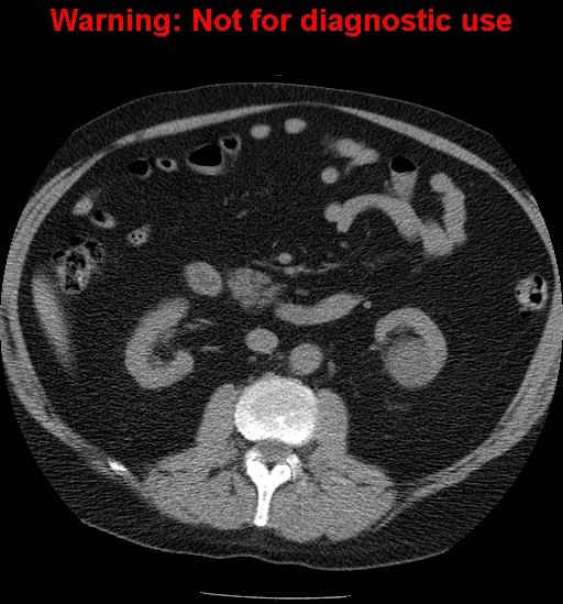 File:Bosniak renal cyst - type IV (Radiopaedia 23402-23466 Axial non-contrast 13).jpg