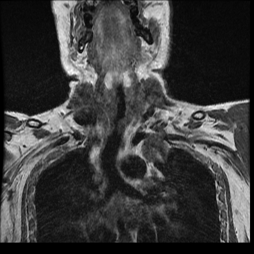 File:Brachial plexus neurofibroma (Radiopaedia 28030-28291 Coronal T1 11).png