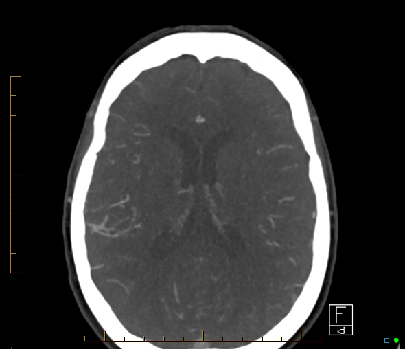 File:Brachiocephalic trunk stenosis (Radiopaedia 87242-103519 A 29).jpg