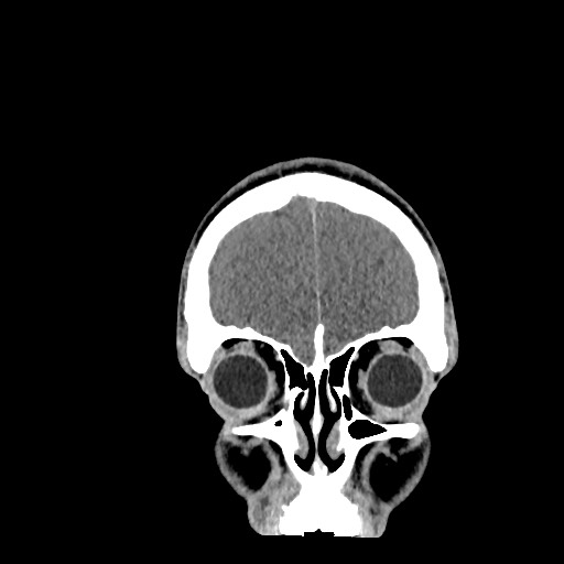 Brain death (Radiopaedia 78597-91360 Coronal non-contrast 13).jpg
