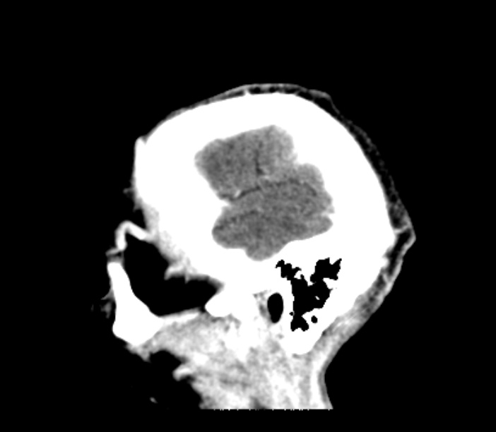 Brain metastases from lung cancer (Radiopaedia 27849-28092 Sagittal C+ delayed 8).jpg