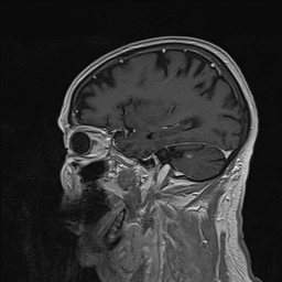 Brain metastasis (Radiopaedia 42617-45761 Sagittal T1 C+ 70).jpg