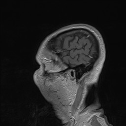 Brain metastasis (Radiopaedia 42617-45761 Sagittal T1 C+ 87).jpg