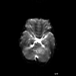 File:Brainstem ganglioglioma (Radiopaedia 10763-11224 Axial DWI 14).jpg