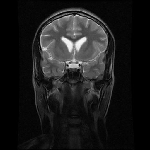 File:Brainstem glioma (Radiopaedia 30923-31624 Coronal T2 13).jpg