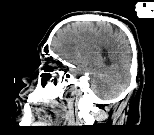 Brainstem hemorrhage (Radiopaedia 81294-94976 C 21).jpg