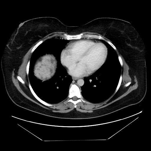Breast cancer pseudocirrhosis after chemotherapy (Radiopaedia 65407-74457 A 5).jpg