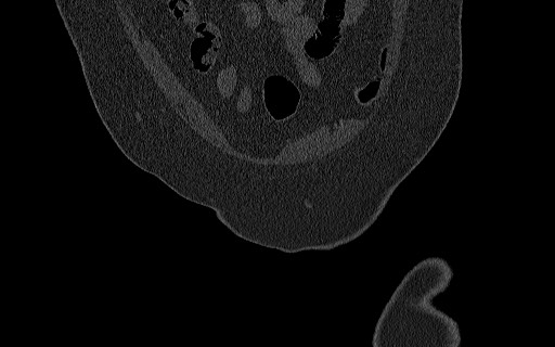 Breast carcinoma with pathological hip fracture (Radiopaedia 60314-67993 Coronal bone window 32).jpg