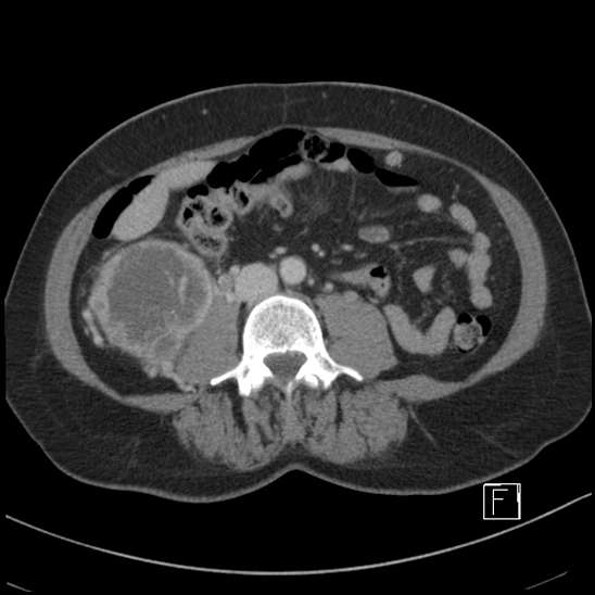 File:Breast metastases from renal cell cancer (Radiopaedia 79220-92225 C 59).jpg