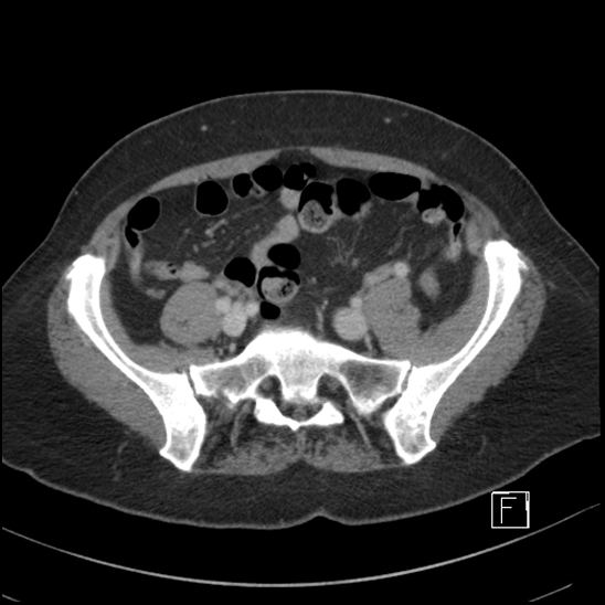 File:Breast metastases from renal cell cancer (Radiopaedia 79220-92225 C 83).jpg