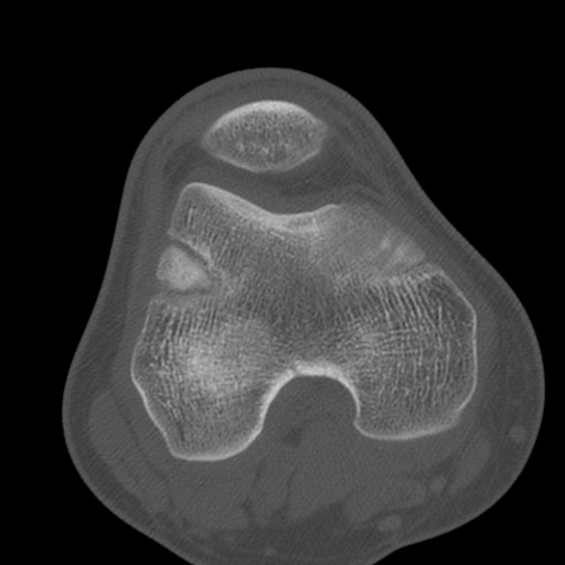 Brodie abscess of the tibia (Radiopaedia 58984-66250 Axial bone window 37).jpg