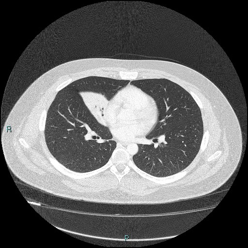 Bronchial carcinoid tumor (Radiopaedia 78272-90875 Axial lung window 27).jpg