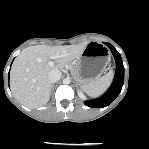 File:Bronchial carcinoid tumor causing right lower lobe collapse (Radiopaedia 83495-98594 A 53).jpg