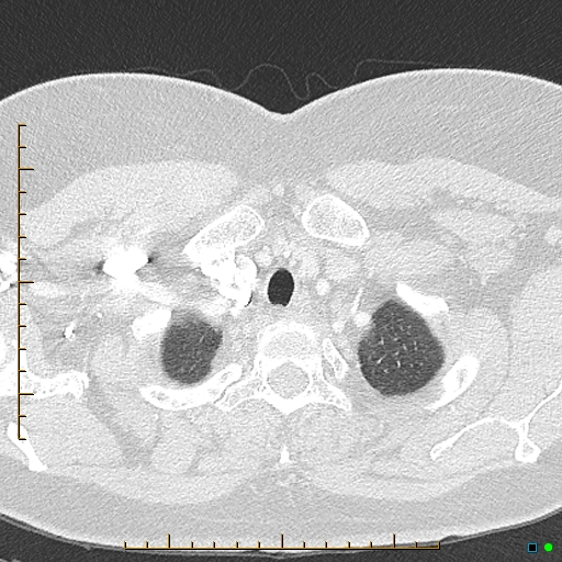 Bronchial diverticula (Radiopaedia 79512-92676 Axial lung window 6).jpg