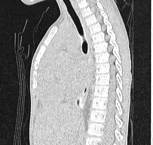Bronchiolitis obliterans (Radiopaedia 71538-81897 Sagittal lung window 35).jpg