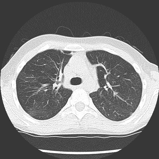 File:Bronchiolotis obliterans (Radiopaedia 73769-84575 Axial lung window 17).jpg
