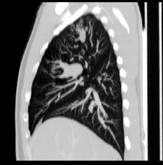 File:Bronchocele (Radiopaedia 12104-12460 Sagittal lung window 6).jpg