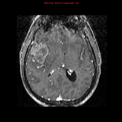 File:Bronchogenic carcinoma brain metastasis (Radiopaedia 9286-9969 Axial T1 C+ 5).jpg