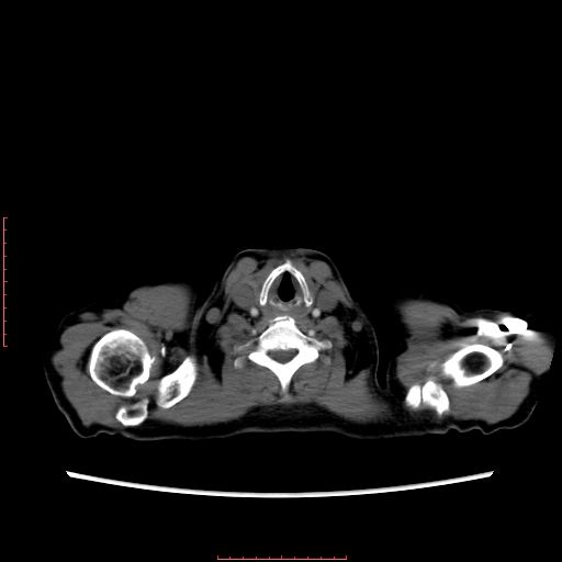 File:Bronchogenic carcinoma with left atrial large deposit - T4N3M1a (Radiopaedia 42316-45428 A 2).jpg