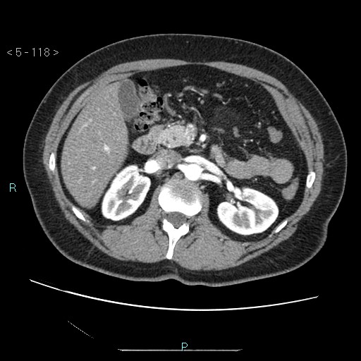 Bronchogenic cyst - posterior mediastinal (Radiopaedia 43885-47364 A 68).jpg