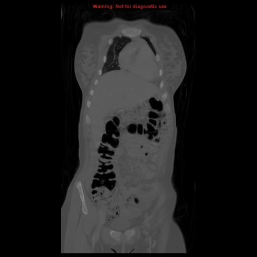 File:Brown tumor (Radiopaedia 12318-12596 D 20).jpg