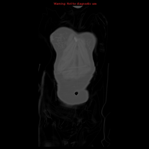 File:Brown tumor (Radiopaedia 12318-12596 D 9).jpg